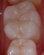 Restauraciones: Después.