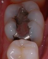 Restauraciones: Antes.